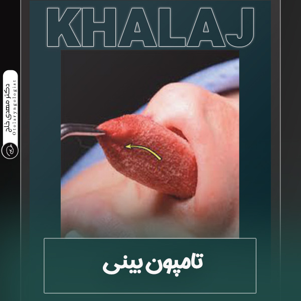 تامپون بینی