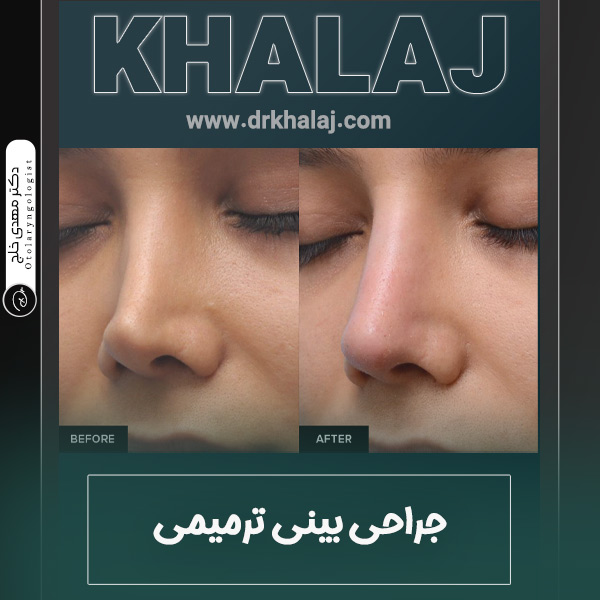 عکس جراحی بینی ترمیمی