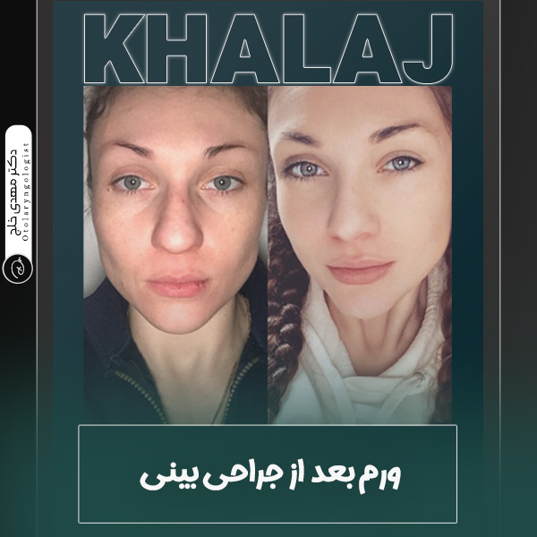 ورم بینی بعد از عمل