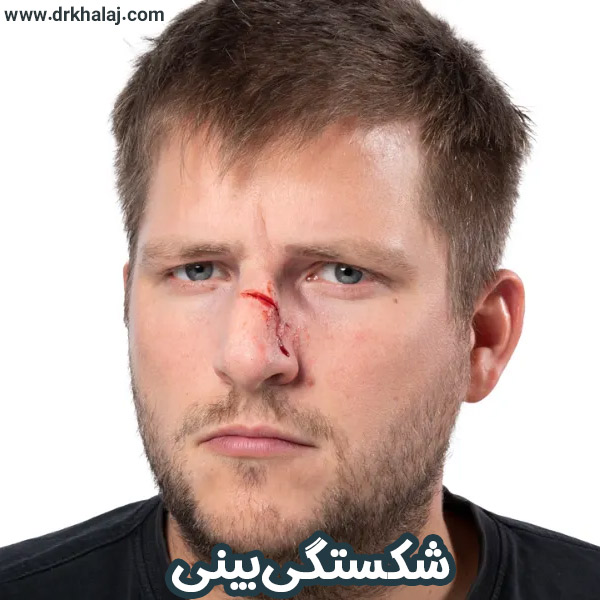 شکستگی بینی 