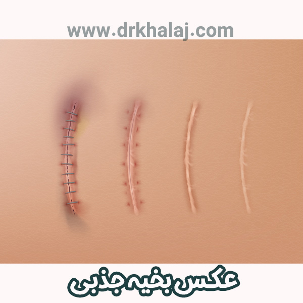 عکس بخیه جذبی