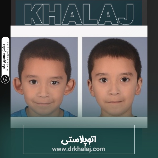 اتوپلاستی