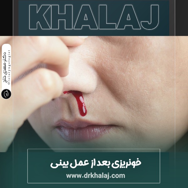 خونریزی بعد از عمل بینی